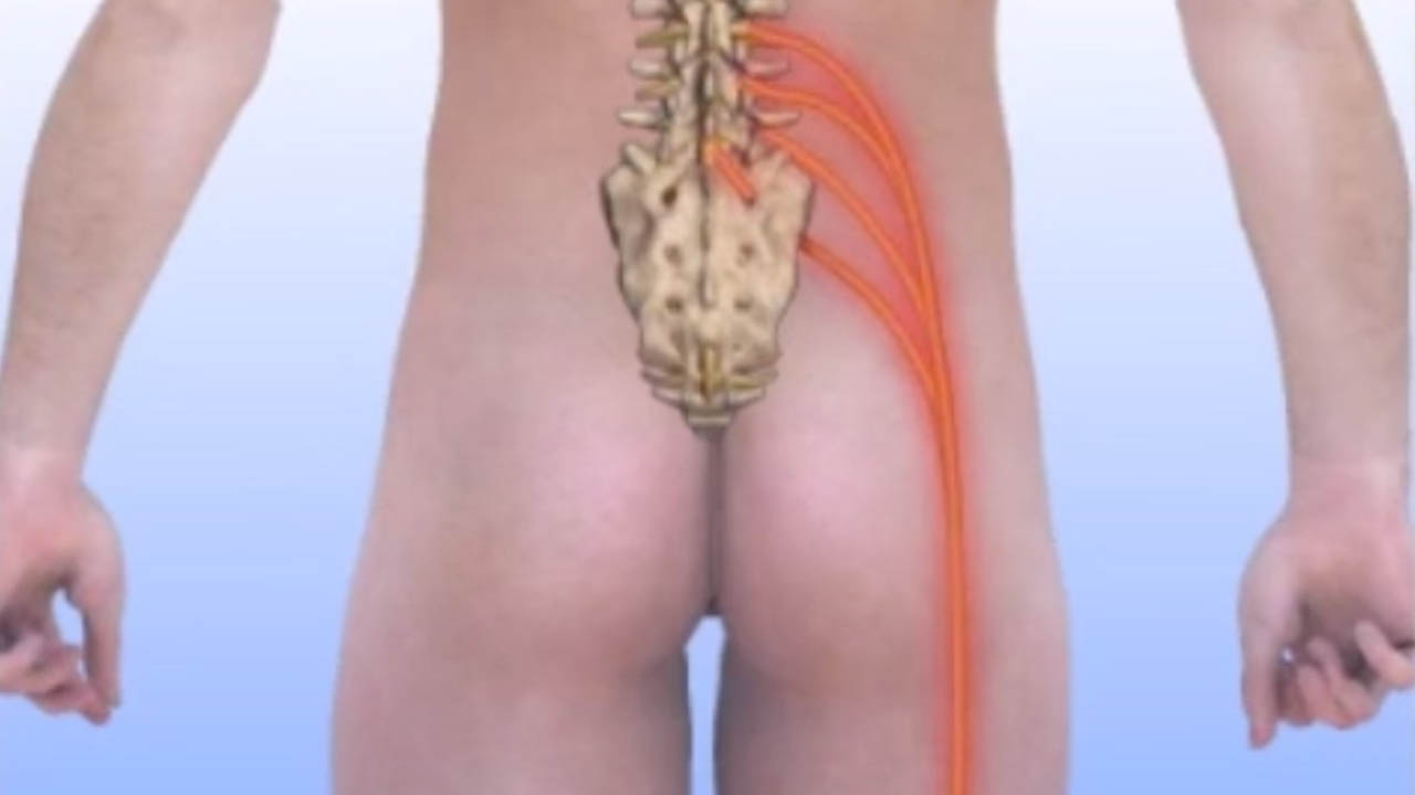 Diagram showing the sciatic nerve path from the lower spine through the buttock and down the leg