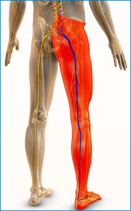 Sciatic nerve pain illustration showing nerve path from lower back down the leg